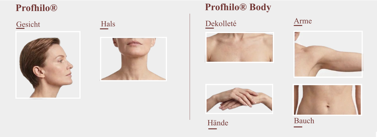 Behandlungsbereiche von Profhilo
